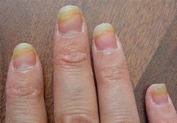 Грибок ногтей на руках